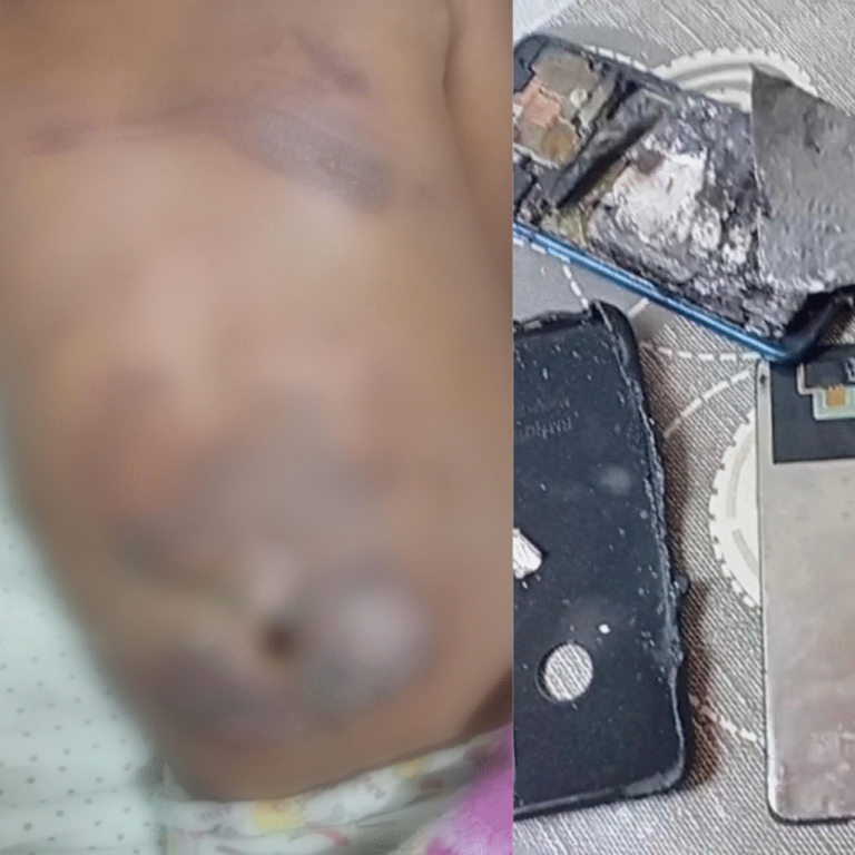 crianca-de-10-anos-sofre-queimaduras-apos-celular-pegar-fogo