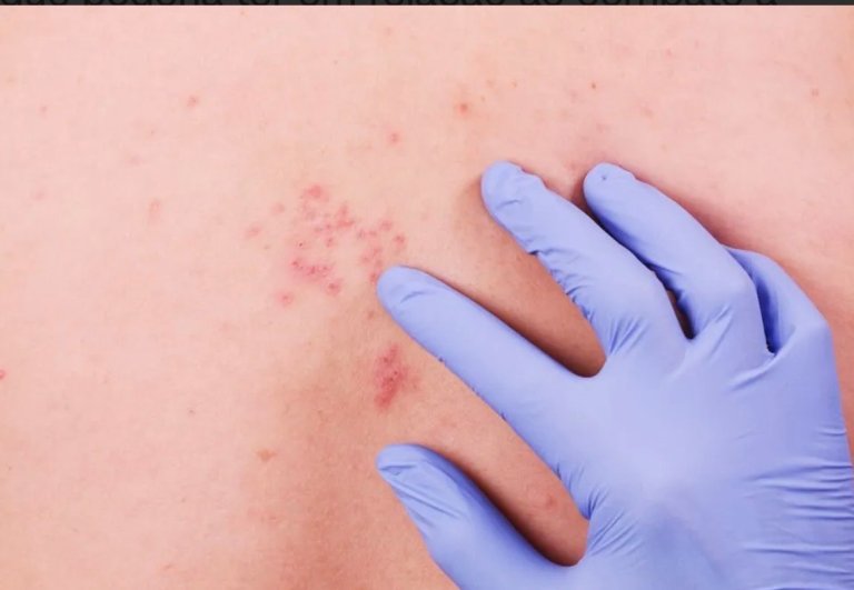 ministerio-da-saude-decide-nao-incorporar-vacina-do-herpes-zoster-ao-sus