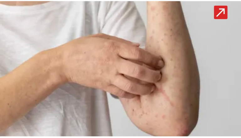 ministerio-da-saude-confirma-caso-de-sarampo-no-rio-de-janeiro